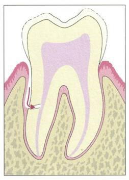 Obrázek č. 8: Primárně parodontologické postižení, cesta infekce postupuje z parodontu do pulpy, pulpa je vitální. Zdroj: KOVAL OVÁ, E., ŤAPAJOVÁ, Z. Parodontológia I. 1. vyd.