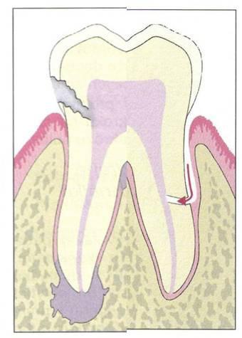 3 Kombinace obou postižení Pulpa zubu není vitální a parodontální chobot sahá až po apex. Jde o propojení parodontitidy a periapikální léze.