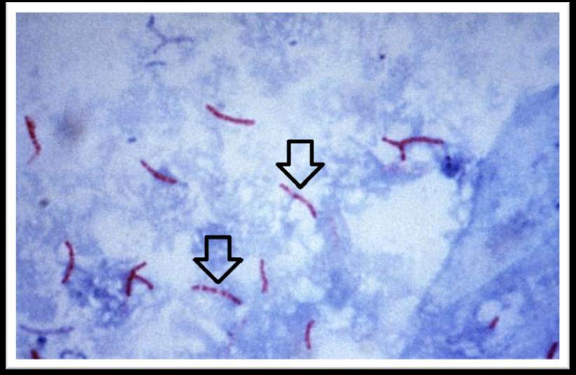 Obr. 3 Muchova granula (nepravidelně probarvené, zrnité, tyčinky Mycobacterium tuberculosis) Tento obrázek odhaluje, že se některé mykobakterie (růžově zbarvené tyčinky) zcela neprobarvily (označeny
