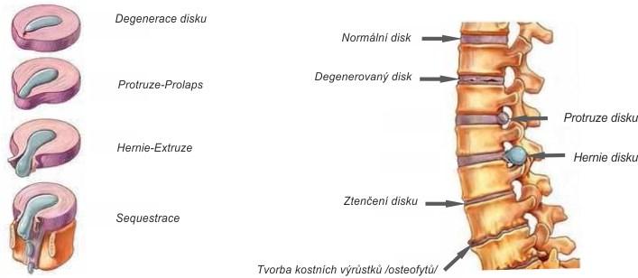 Paramediální prolaps působí stejné potíže jako laterální prolaps, ale vyskytne se později. Díky tomuto prolapsu dochází navíc k útlaku i sousedního kořene (kořen ve stejné etáži).