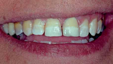 3: Pohled na kompletní sadu Uveneer (Dental Art Innovations) obsahující šablony ve dvou velikostech k dosažení estetického výsledku u většiny zubů Obr.