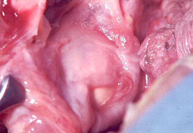 occlusion Antiaspiration