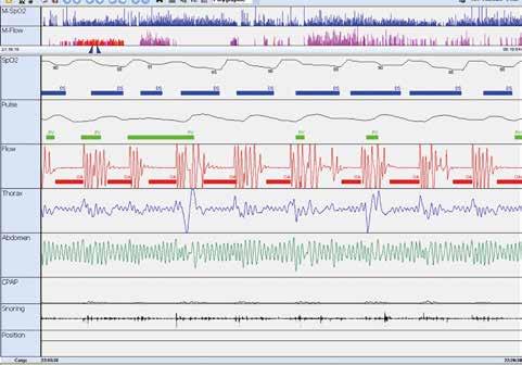 3 Obr. 1. Pětiminutová část záznamu limitované polysomnografie; v 1. řádku je zobrazena saturace hemoglobinu kyslíkem, kde modré obdélníky oznažují poklesy saturace, 2.