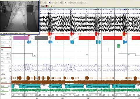 4 Online príloha Obr. 3. Pětiminutová část záznamu kompletní videopolysomnografie; v levém rohu záznamu je na obrazovce pacient, který je snímán kamerou v infračerveném světle.