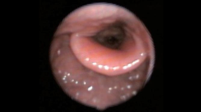 Kezirian EJ, Hohenhorst W, de Vries N (2011) Drug-induced sleep endoscopy: the VOTE