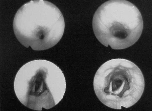 Clin Otolaryngol 1991; 16: 559-562 Drug Induced Sleep Endoscopy (DISE)