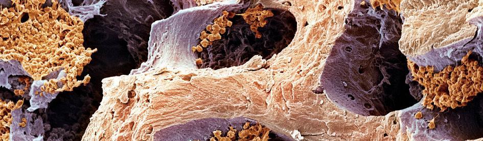 NANOPROGRESS OBNOVUJEME ZRANĚNÉ KOSTI Díky metodě přípravy koaxiálních nanovláken byla vyvinuta kostní výplň,