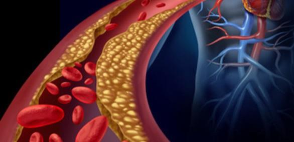 Poruchy metabolizmu lipidů primární hyperlipoproteinémie geneticky podmíněné, obvykle spojeno s DM, HT, hyperurikémií urychlení AS dělení dle Fredericksona typ