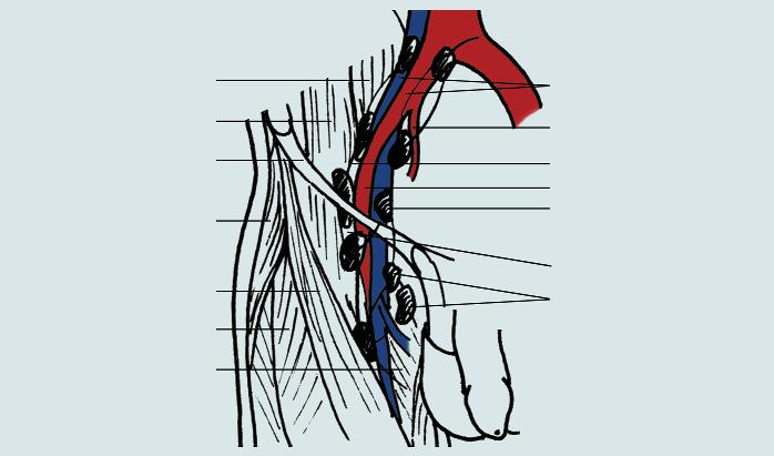 Musculus psoas major Musculus iliacus Ligamentum inguinale M. tensor fasciae latae Musculus sartorius Musculus rectus femoris M. adductor magnus Obr. 4. Hluboké ingvinální uzliny.