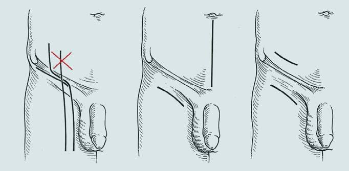 A B C Obr. 6. Kožní řezy. Obr. 7. Klasická a modifikovaná lymfadenektomie (Catalona). 20 cm Lig. inguinale Vv. circumfexae femoris laterales 11 cm 12 cm Obr. 8.