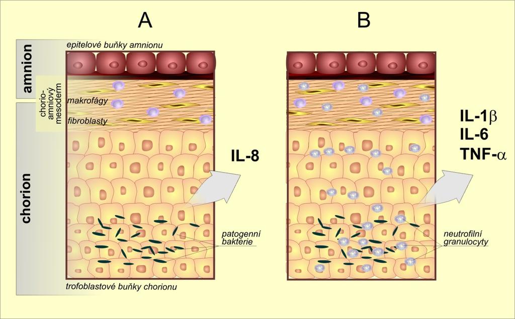 Obrázek 5 Schematické znázornění počátku zánětu v plodových obalech (chorioamnionitidy). A. Mikrobiální invaze indukuje v buňkách plodových obalů produkci interleukinu (IL)-8. B.