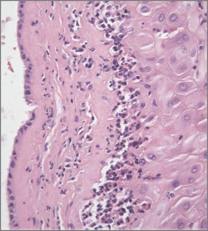 Diagnostika PPROM V současné době je nejvíce používaným testem k průkazu PPROM tzv.