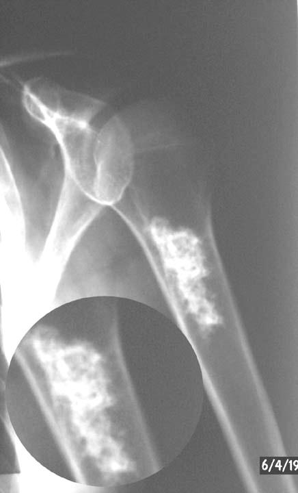 Ischemické osteopatie Aseptické nekrózy