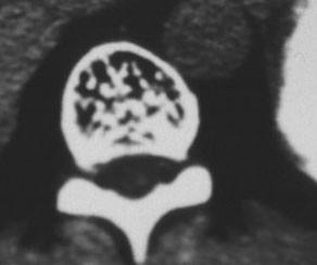 fibrom Tvořící kost : osteom, osteoidní osteom,