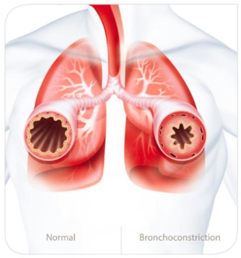 Dýchání ústy snižuje dechovou práci Mnoho pacientů na NIV má dýchací obtíže a dýchají ústy.