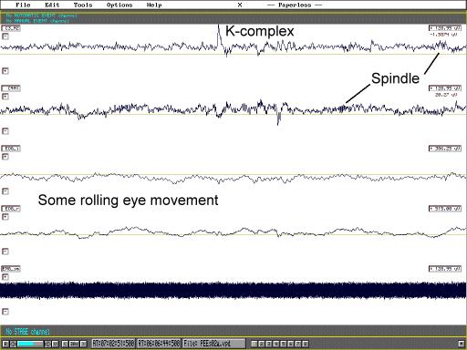 2.stadium NonREM EEG: θ aktivita, K-komplexy,