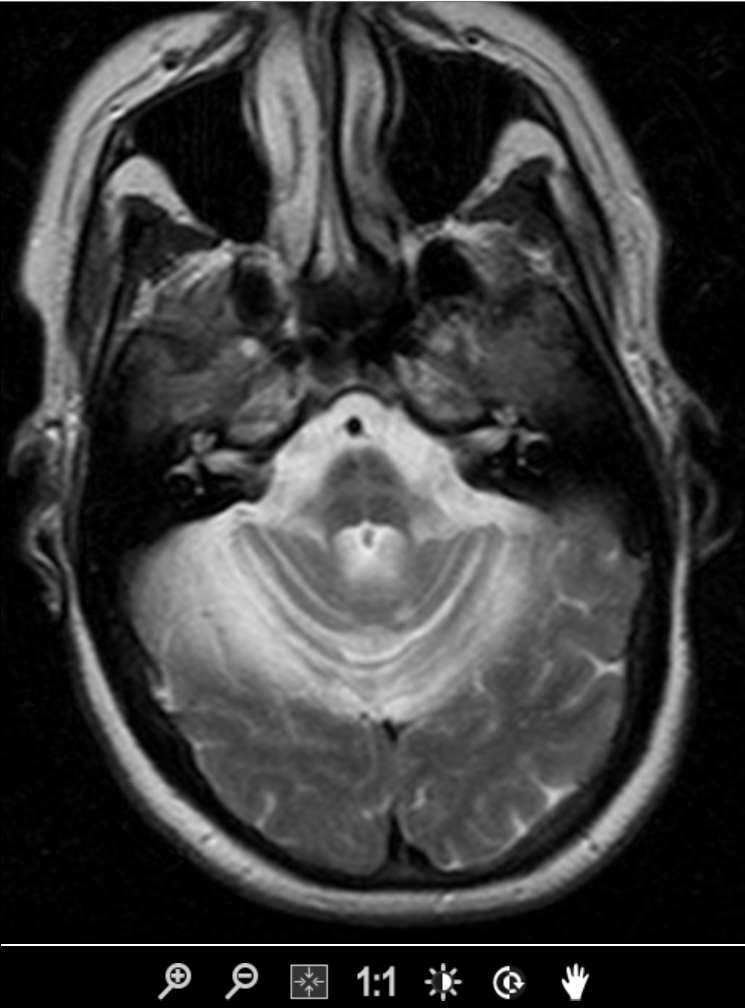 55-year-old woman presents with an abnormal gait 55 letá žena s poruchou chůze T2 W MR horizontální řez hot cross bun sign in the pons