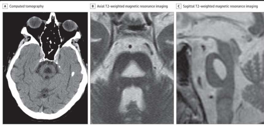 Images in Neurology December 28, 2015 Striking Central Pontine Myelinolysis in a Patient With Alcohol Dependence Syndrome Without Hyponatremia Patricia H.