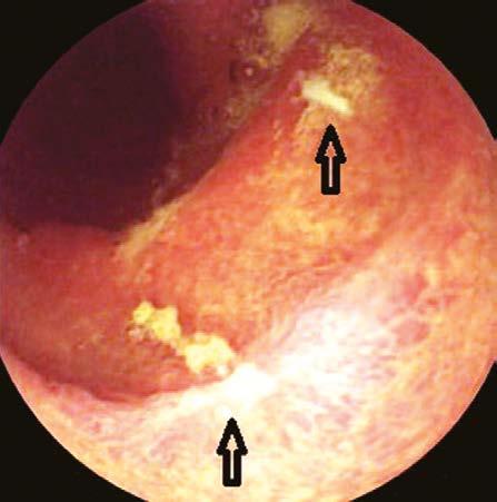 Obr. 1. Malé vředy tenkého střeva při NSAID terapii, obrázek z kapslové enteroskopie H2 blokátory, sukralfát a antacida nejsou dostatečně účinná, zejména pokračuje-li léčba NSAID (10).
