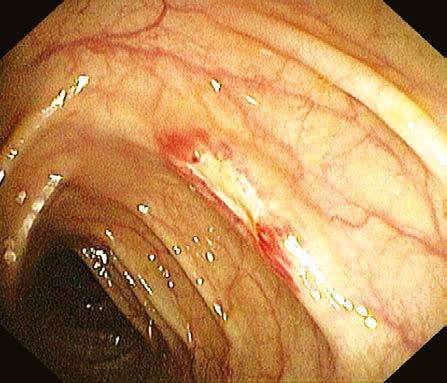 Obr. 2. Vřed colon ascendens při NSAID terapii, obrázek z koloskopie Enteropatie z NSAID Nežádoucí účinky NSAID se projevují i distálně od duodena.