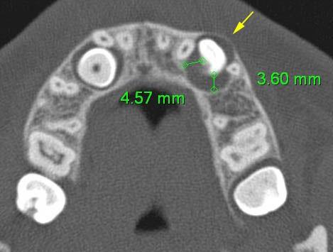 9. Prostorové poměry v postranním úseku horního zubního oblouku na postižené straně nedostatek místa pro prořezávající špičák (Prostor mezi kořeny postranního řezáku a prvního premoláru měřený na