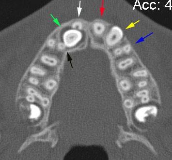 Obr. 18a Obr. 18b Obr. 18c Obr. 18d Obr. 18 CT snímky třináctileté pacientky s oboustrannou agenezí horních stálých postranních řezáků.