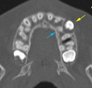 Obr. 19a Obr. 19b Obr. 19c Obr. 19d Obr. 19 CT snímky dvanáctiletého pacienta. (a) Axiální CT sken horní čelisti.