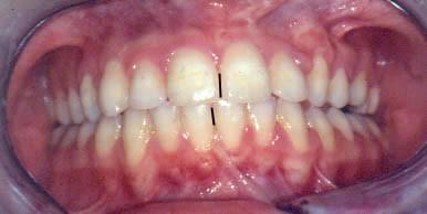 Obr. 24 Intraorální pohled v průběhu ortodontické léčby.