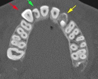 stálým levým špičákem. (a, b) Axiální CT skeny horní čelisti.