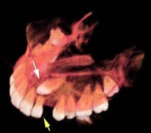 Korunka retinovaného špičáku (bílá šipka) je umístěna palatinálně ve vztahu k zubnímu