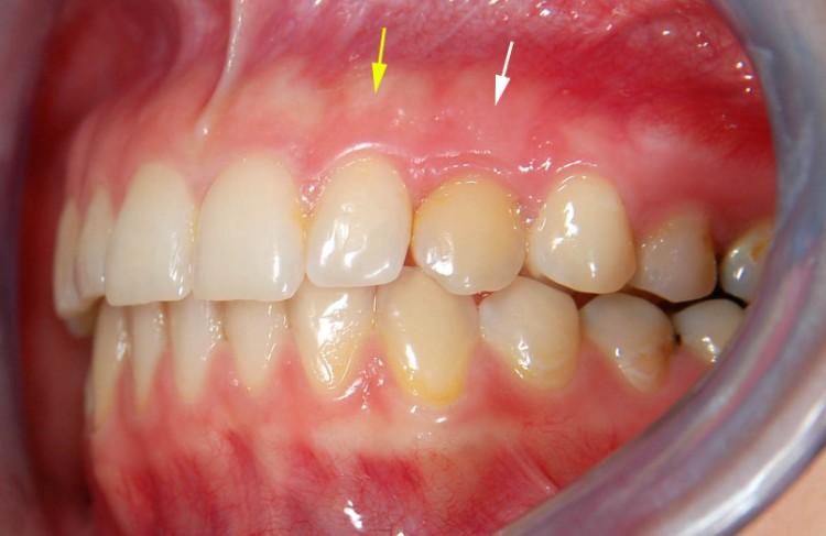 Obr. 37c Intraorální pohled v období 16 měsíců po aktivní ortodontické