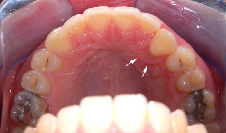 38 Intraorální pohled na horní zubní oblouk v době 5 měsíců před (obr.
