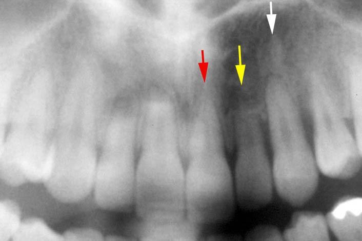 Horní stálý levý špičák (bílá šipka) je vyrovnaný v zubním oblouku. Je patrná ztráta kosti kolem jeho kořene.