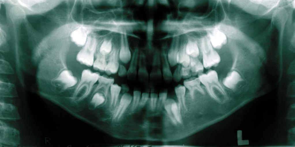 Obr. 1d Obr. 1 Ortopantomogramy dívky, které byly indikovány pro diagnostiku patologického vyklenutí v oblasti levého dolního špičáku. Obr. 1a Ortopantomogram zhotovený ve věku 5 let a 3 měsíce.