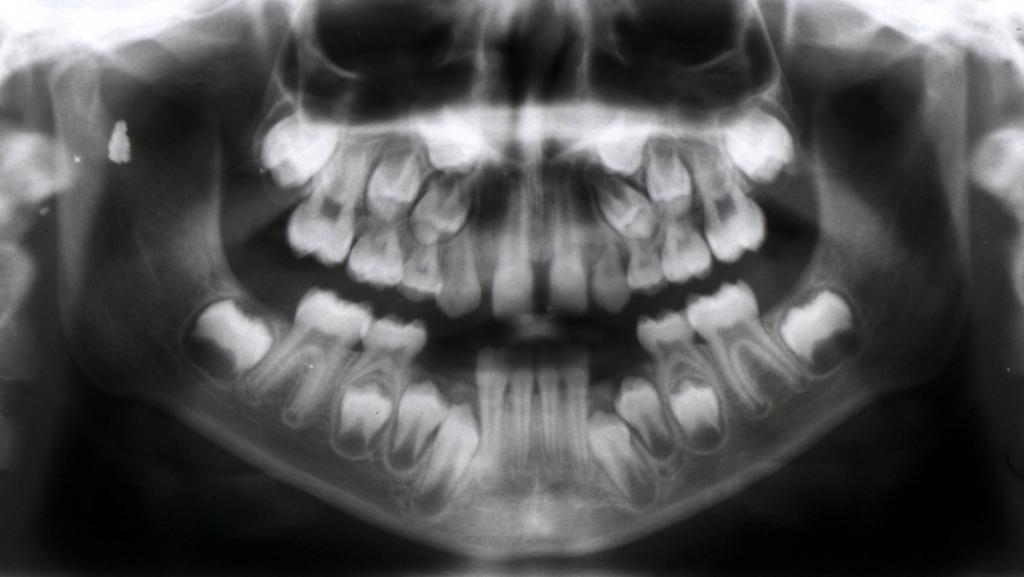 Obr. 2a Ortopantomogram pacienta ve věku 9 let. Jsou patrné nezaloţené stálé horní postranní řezáky.