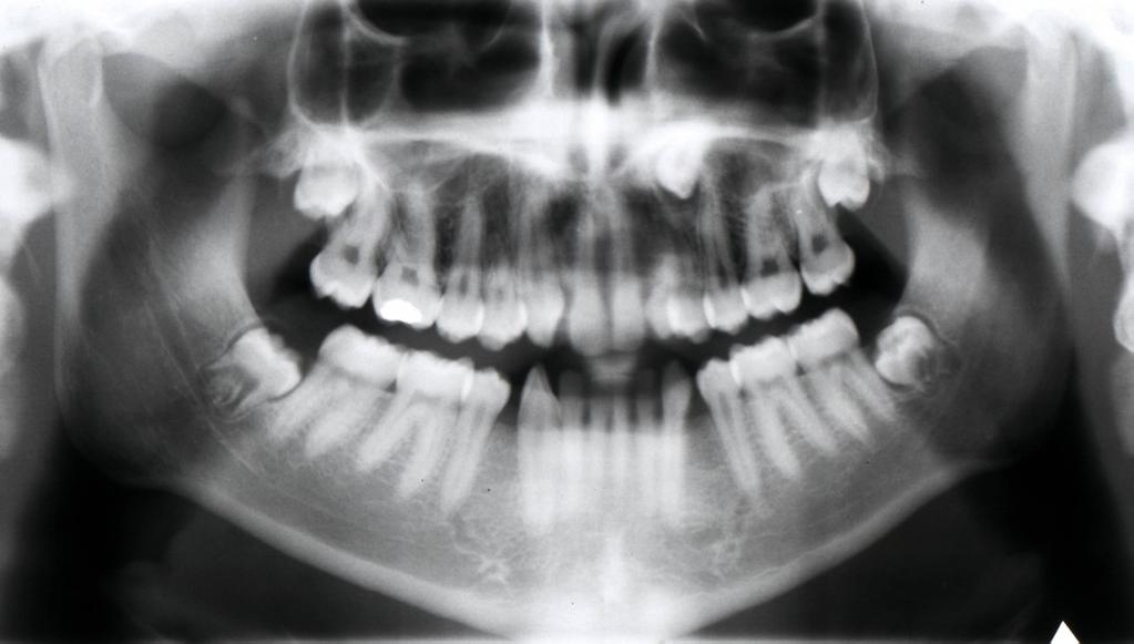 Poloha zárodků jednotlivých zubů a stav jejich prořezání je symetrický na pravé a levé straně. Jedná se o iniciální fázi intraoseální erupční dráhy horních stálých špičáků. Obr.