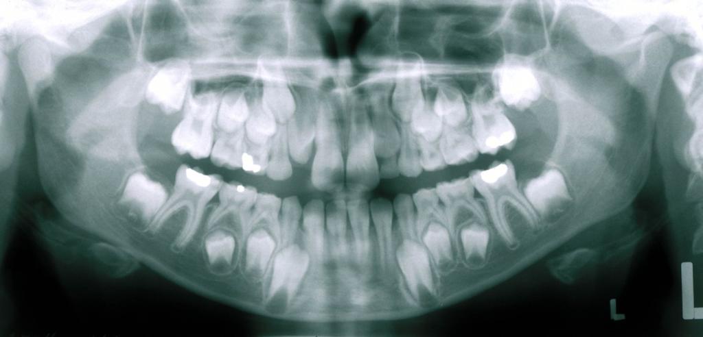 Obr. 3a Ortopantomogram chlapce ve věku 9 let a 1 měsíc. Zárodky horních stálých špičáků jeví známky pokračujícího vývoje kořene.