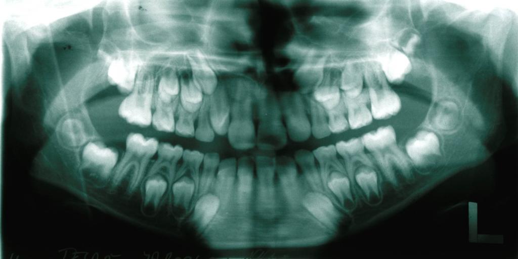Poloha a stav jednotlivých zubů v pravém a levém horním kvadrantu je symetrický s výjimkou zárodku korunky stálého pravého postranního řezáku, který jeví známky rotace. Obr.
