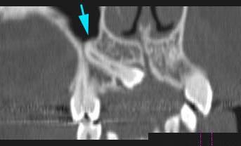 6b Ortopantomogram stejné pacientky ve věku 17 let a 7 měsíců. Jsou patrny zárodky korunek třetích molárů.