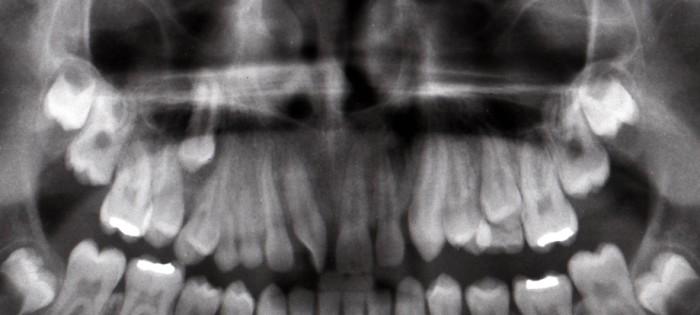 Obr. 15a Detail z OPG Obr. 15b 3D CT Obr. 15 Radiologická dokumentace třináctiletého pacienta. Pravý horní stálý špičák je v transpozici s prvním premolárem.