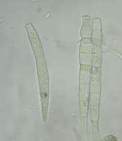 Hnědá stonková hniloba a spála květů kmínu (Mycocentrospora acerina) Symptomy: