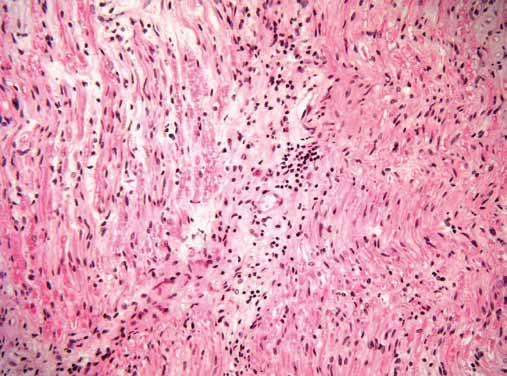 Úvod Chronická zánětlivá demyelinizační polyradikuloneuropatie (CIDP) je imunitně zprostředkovaná neuropatie s heterogen ní klinickou manifestací [1].