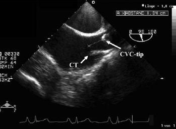 pravý tracheobronchiální úhel 3 1. Journal of Electrocardiology 43 (2010) 274 278 2.