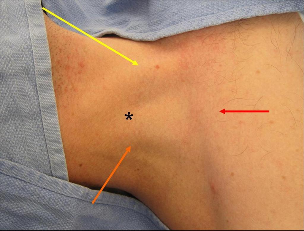 Vena jugularis interna centrálním přístupem Sedillotův trojúhelník ve vrcholu na bradavku 1-1,5 cm, max.