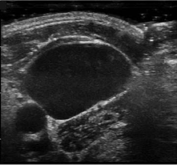 Orientace úkosu při punkci vena jugularis interna dx.