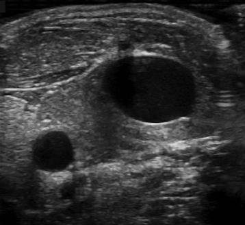 Orientace úkosu při punkci vena jugularis interna dx.? Lim T et al.