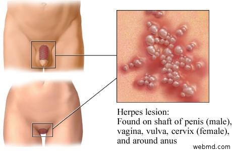 Herpes