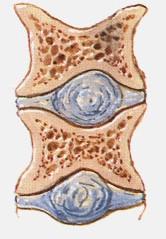 rozvláknění kosti Resorpce a osteolýzy