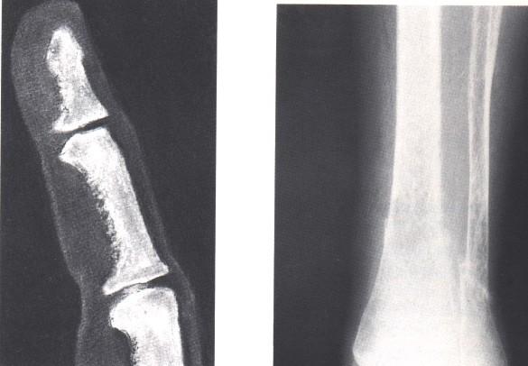 Sek. HPT u renálních chorob - renální osteodystrofie Bolest v kostech, únava, obtížné vstávání ze sedu,