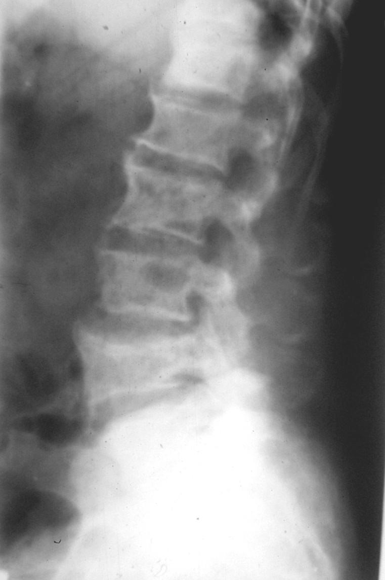 Rozšíření a zvětšení os sacrum